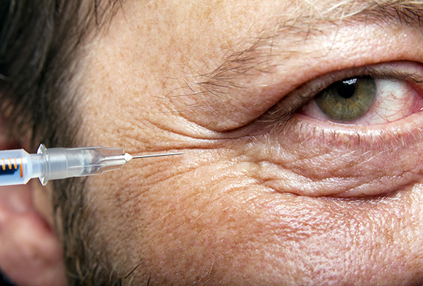 faltenbehandlung-auge
